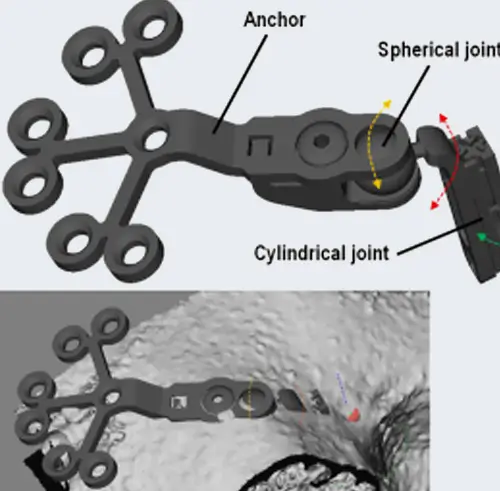 Bone-Anchored-Hearing-Aids